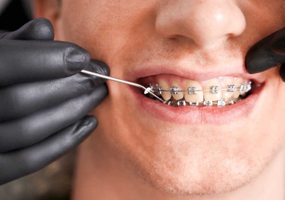 Close up of dentist hands in sterile gloves putting elastic rubber band on patient brackets. Man with wired metal braces on teeth receiving orthodontic treatment in dental clinic. Concept of dentistry